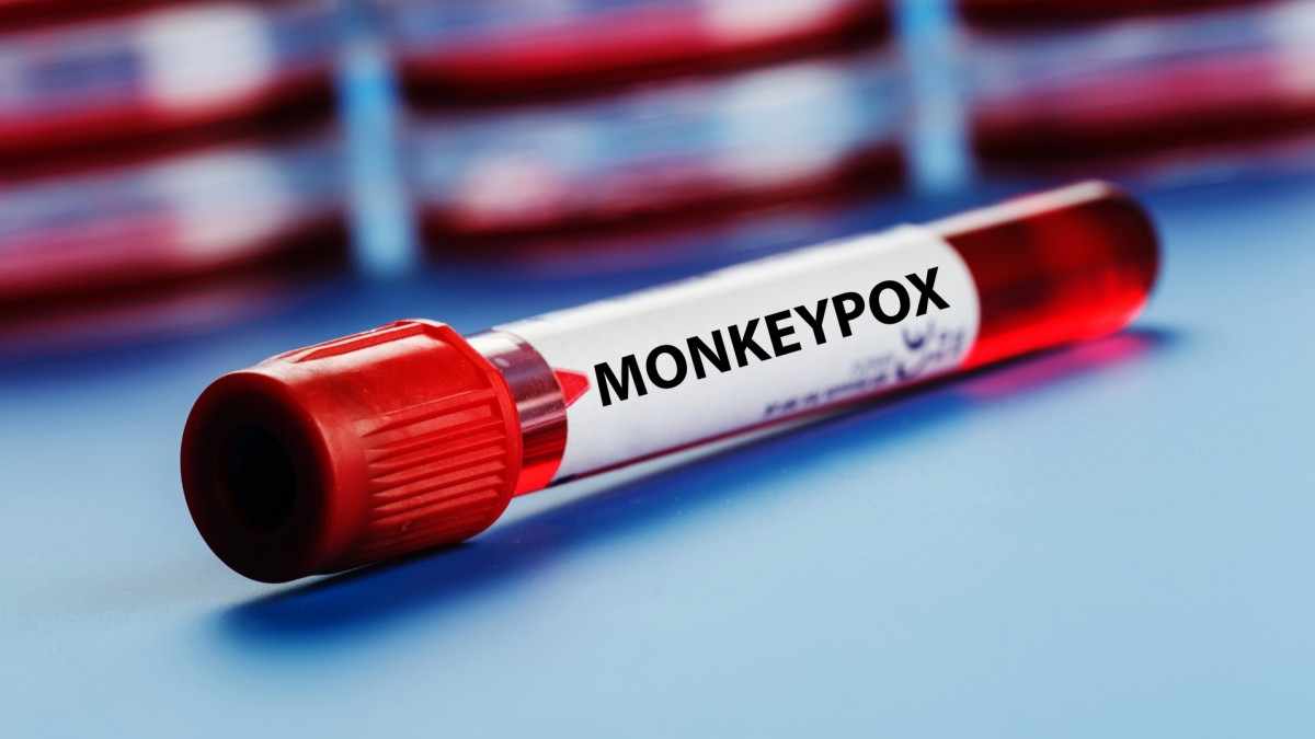 monkeypox-thefreemedia-The-Free-Media